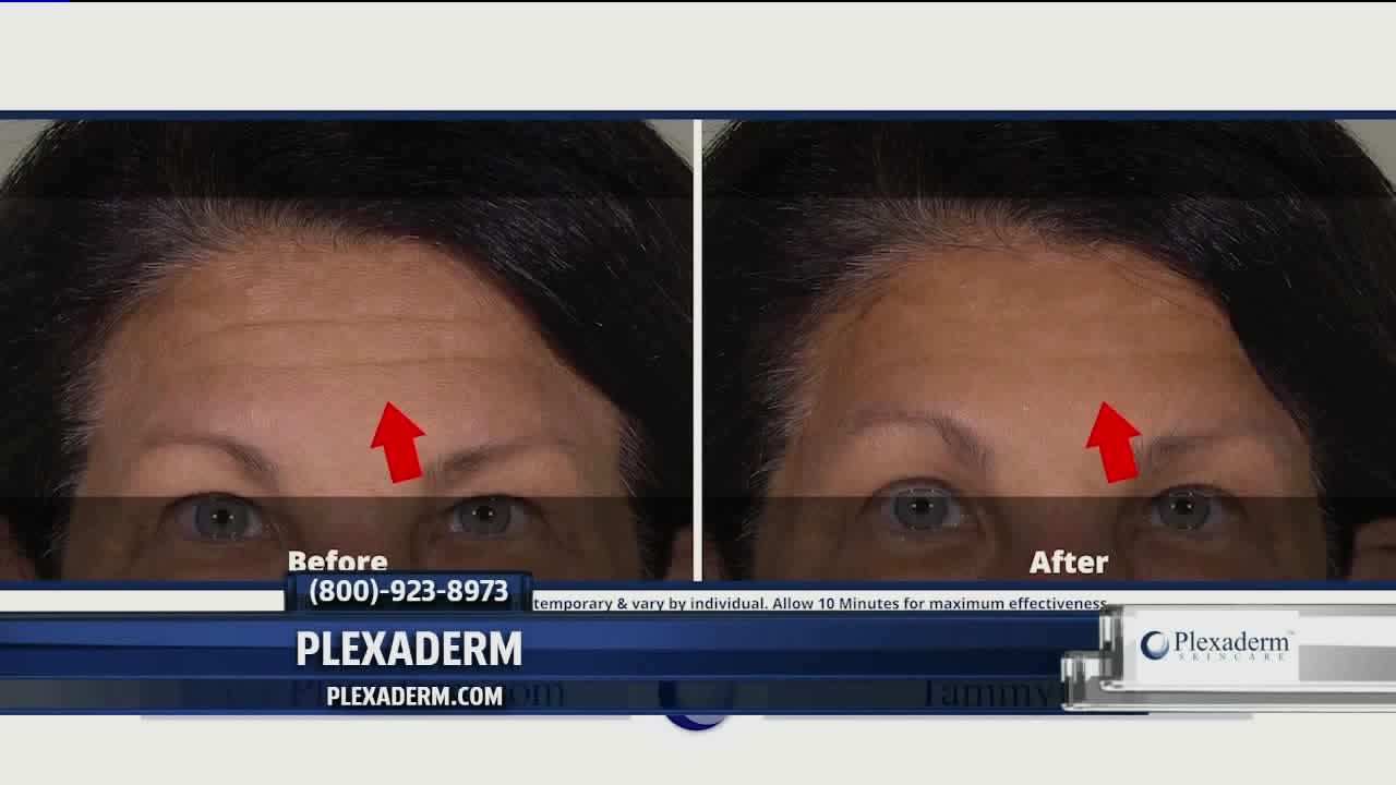 plexaderm forehead wrinkles