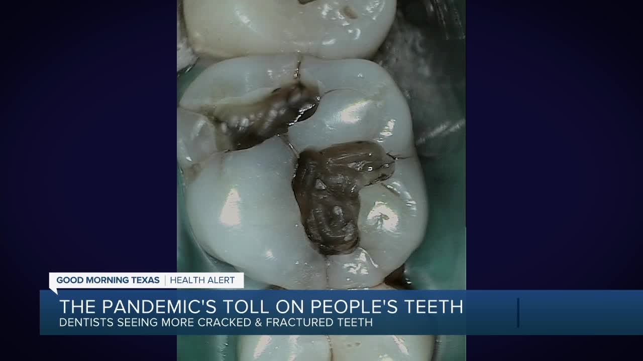 Dentists see spike in cracked teeth amid pandemic - Vimarsana News